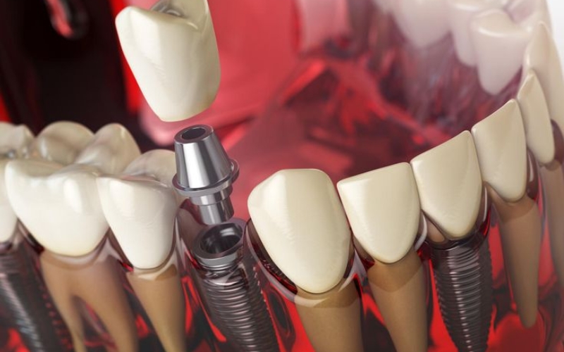 What Older Adults Need To Know About Dental Implants