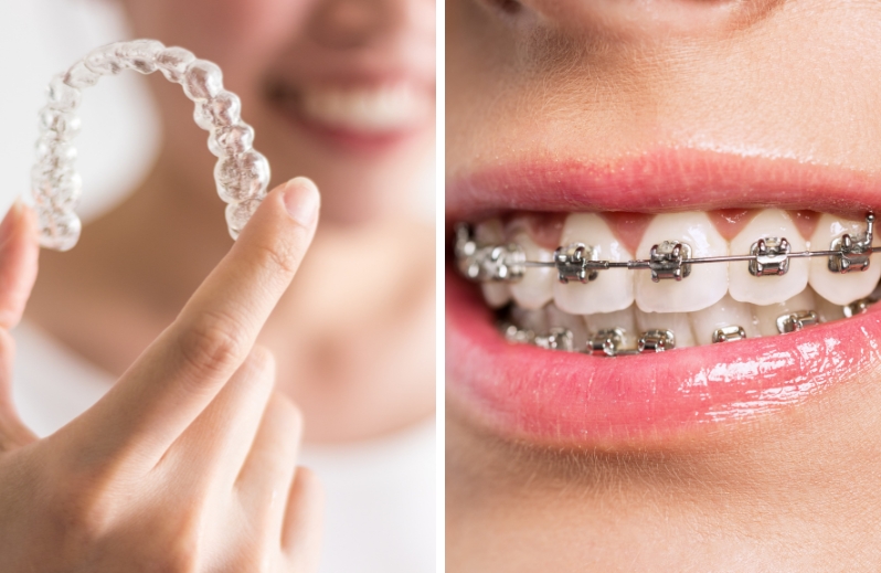 Invisalign provides a smoother ride over braces